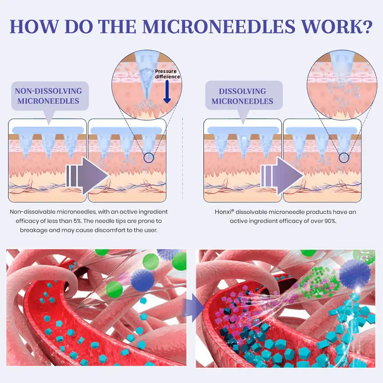 Honxi® NIDDK-Tirzepatide Nano Microneedle Patch 4 Honxi® NIDDK-Tirzepatide Nano Microneedle Patch
