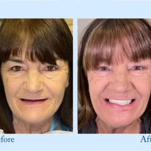 Smileasego™ – Premium Denture