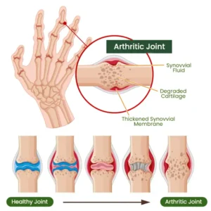 Adfire® Bee Venom Bone & Joint Revive Spray