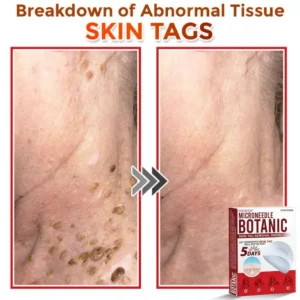 Fivfivgo® MicroNeedle Botanic Skin Tag Removal Patch image Fivfivgo® MicroNeedle Botanic Skin Tag Removal Patch