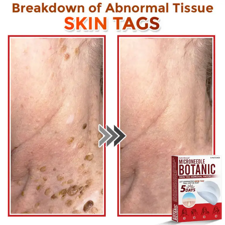 Fivfivgo® MicroNeedle Botanic Skin Tag Removal Patch image Fivfivgo® MicroNeedle Botanic Skin Tag Removal Patch