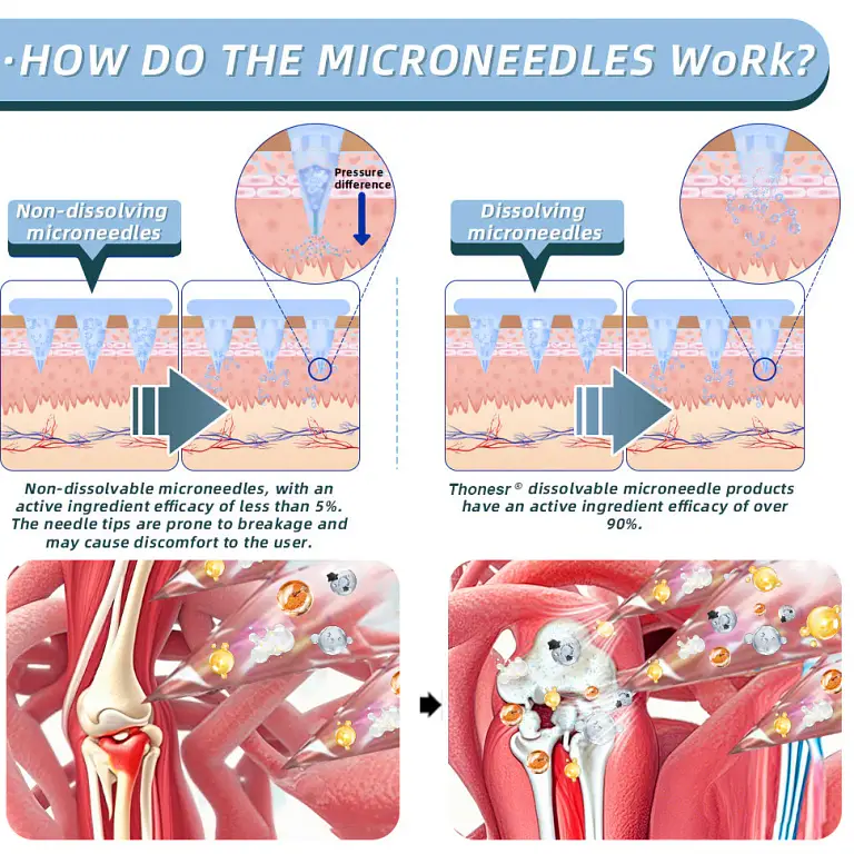 Thonesr® Nano-microneedle joint patch image Thonesr® Nano-microneedle joint patch
