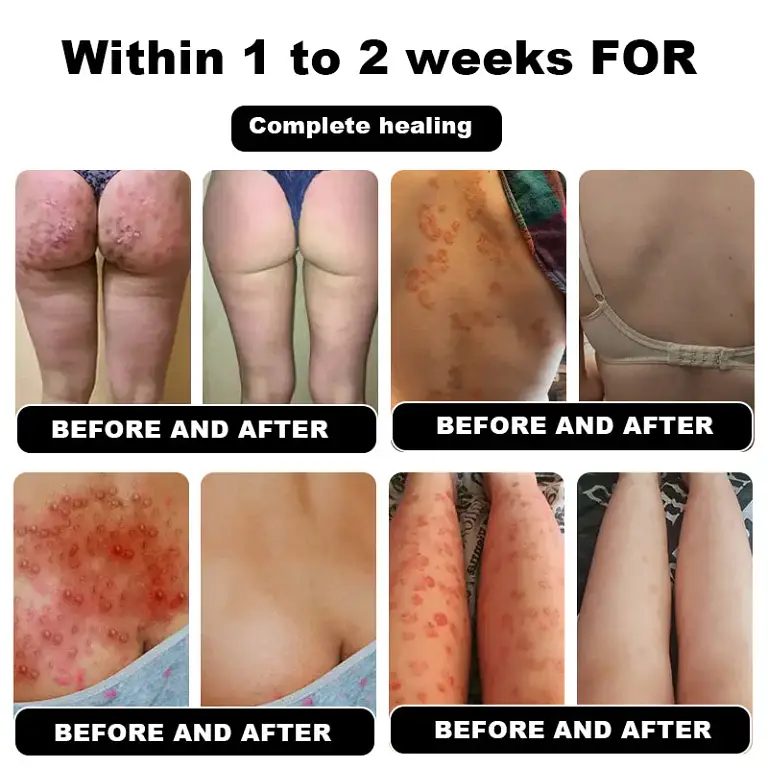 NESLEMY™ Psoriasis Cure Cream