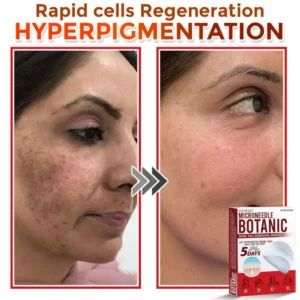 Fivfivgo® MicroNeedle Botanic Skin Tag Removal Patch image Fivfivgo® MicroNeedle Botanic Skin Tag Removal Patch