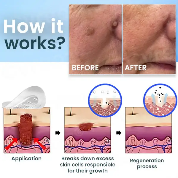 Cvreoz® Nano-Micro Needle Skin Tags Removal Patches | No More Hiding that Skin