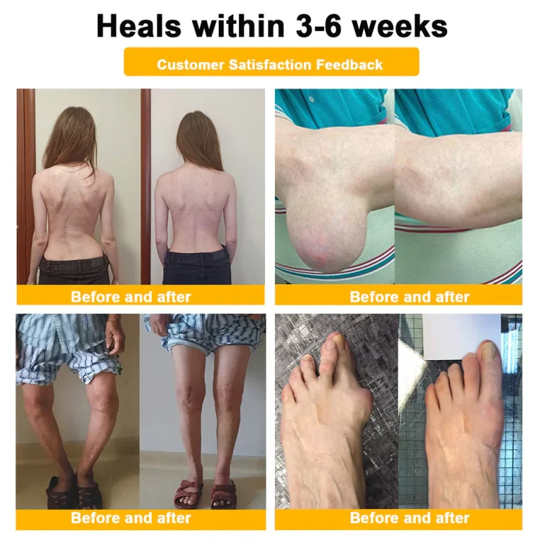 ADNOON™ Botulinum Toxin & Bee Venom Pain-Relief Bone Healing Cream 8 ADNOON™ Botulinum Toxin & Bee Venom Pain-Relief Bone Healing Cream