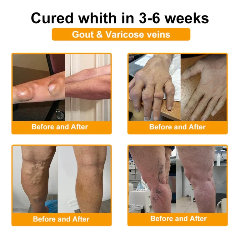 ADNOON™ Botulinum Toxin & Bee Venom Pain-Relief Bone Healing Cream 6 ADNOON™ Botulinum Toxin & Bee Venom Pain-Relief Bone Healing Cream
