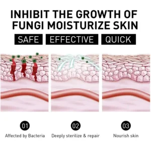 NESLEMY™ Psoriasis Cure Cream