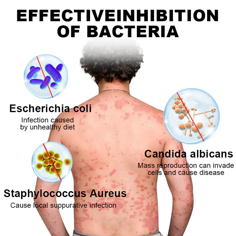 NESLEMY™ Psoriasis Cure Cream
