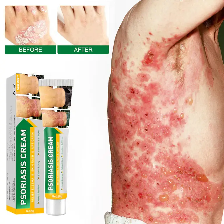 NESLEMY™ Psoriasis Cure Cream