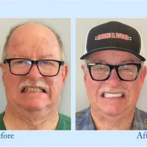 Smileasego™ – Premium Denture