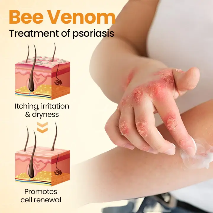 ATTDX® BeeSooth Psoriasis Skin Care Cream