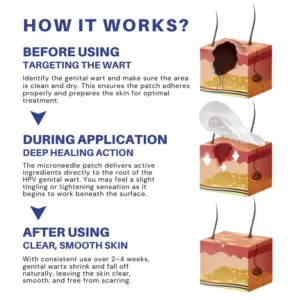 Fivfivgo® Microneedle HPV Genital Warts Removal Patch