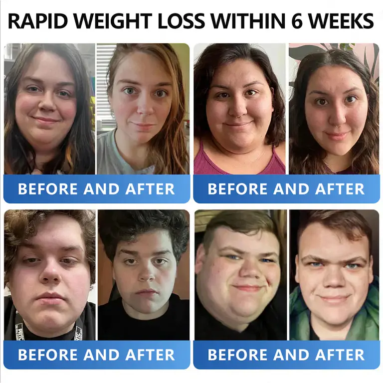 AAFQ® Nano Μicroneedle Patch with SΜGT GLP 1