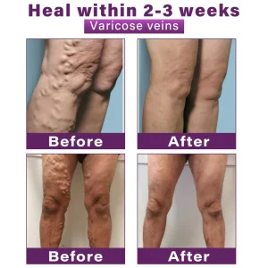 CVREOZ® Polidocanol Nano Varicose Vein Patch 16 CVREOZ® Polidocanol Nano Varicose Vein Patch