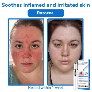 Jasseem® Non-Invasive Mole & Wart Laser Removal Pen