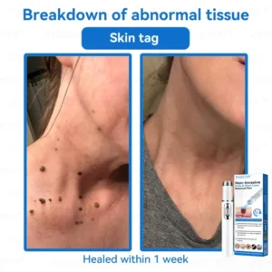 Jasseem® Non-Invasive Mole & Wart Laser Removal Pen