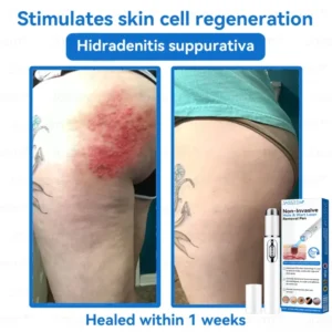 Jasseem® Non-Invasive Mole & Wart Laser Removal Pen