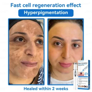 Jasseem® Non-Invasive Mole & Wart Laser Removal Pen