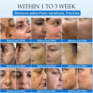 Jasseem® Non-Invasive Mole & Wart Laser Removal Pen