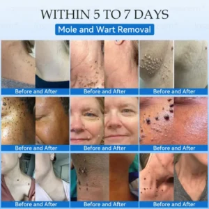 Jasseem® Non-Invasive Mole & Wart Laser Removal Pen