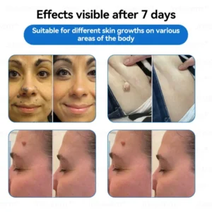 Jasseem® Non-Invasive Mole & Wart Laser Removal Pen