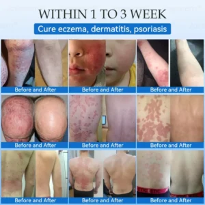 Jasseem® Non-Invasive Mole & Wart Laser Removal Pen