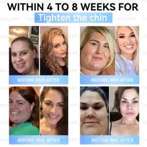 Buildleaf® Tirzepatide Slimming & Health Nano Microneedle Patch