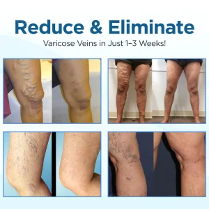 Cvreoz® Herbal Varicose Veins Treatment Spray