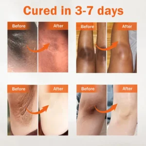 Dobshow® Acanthosis Nigricans Treatment Oil