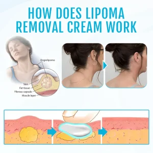 Cvreoz® Lipoma Removal Cream