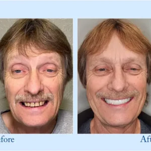 Smileasego™ – Premium Denture