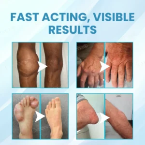 Cvreoz® Joint Relief HA Microneedle Patch