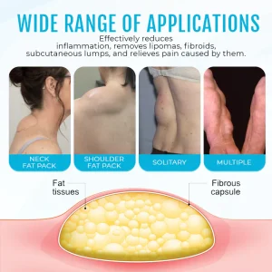 Cvreoz® Lipoma Removal Cream