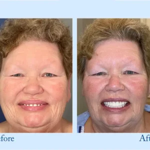 Smileasego™ – Premium Denture