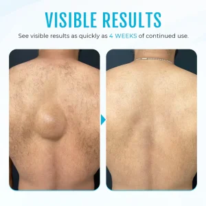 Cvreoz® Lipoma Removal Cream