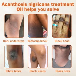 Dobshow® Acanthosis Nigricans Treatment Oil