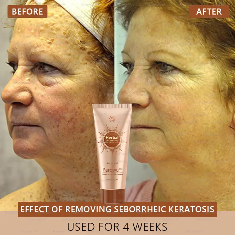 Parowu™ Whitening and Spot-Removing Face Mask Suitable 6 Parowu™ Whitening and Spot-Removing Face Mask Suitable