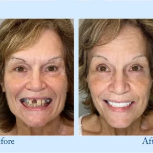 Smileasego™ – Premium Denture