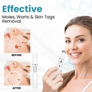 Bikenda® EXTRA Non-Invasive Mole and Wart Removal Laser Pen