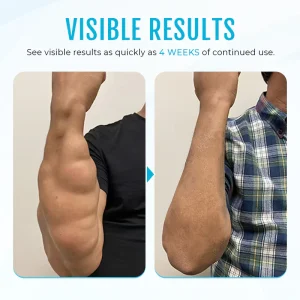 Cvreoz® Lipoma Removal Cream