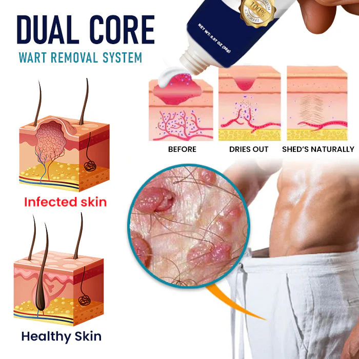 Cvreoz® Genital Warts Remover Cream 3 Cvreoz® Genital Warts Remover Cream