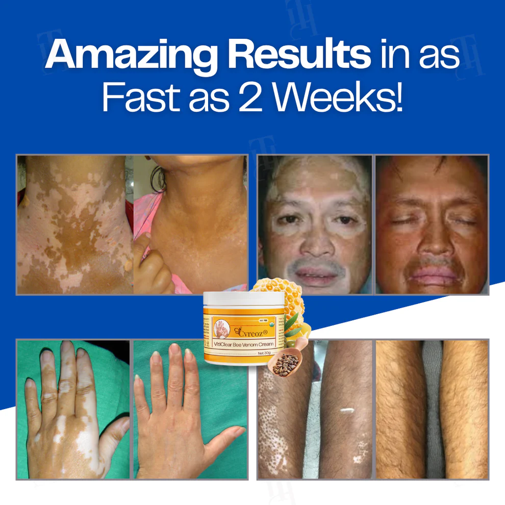 Cvreoz® VitiClear Bee Venom Cream