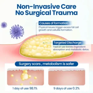 Cvreoz® Lipoma Removal Cream