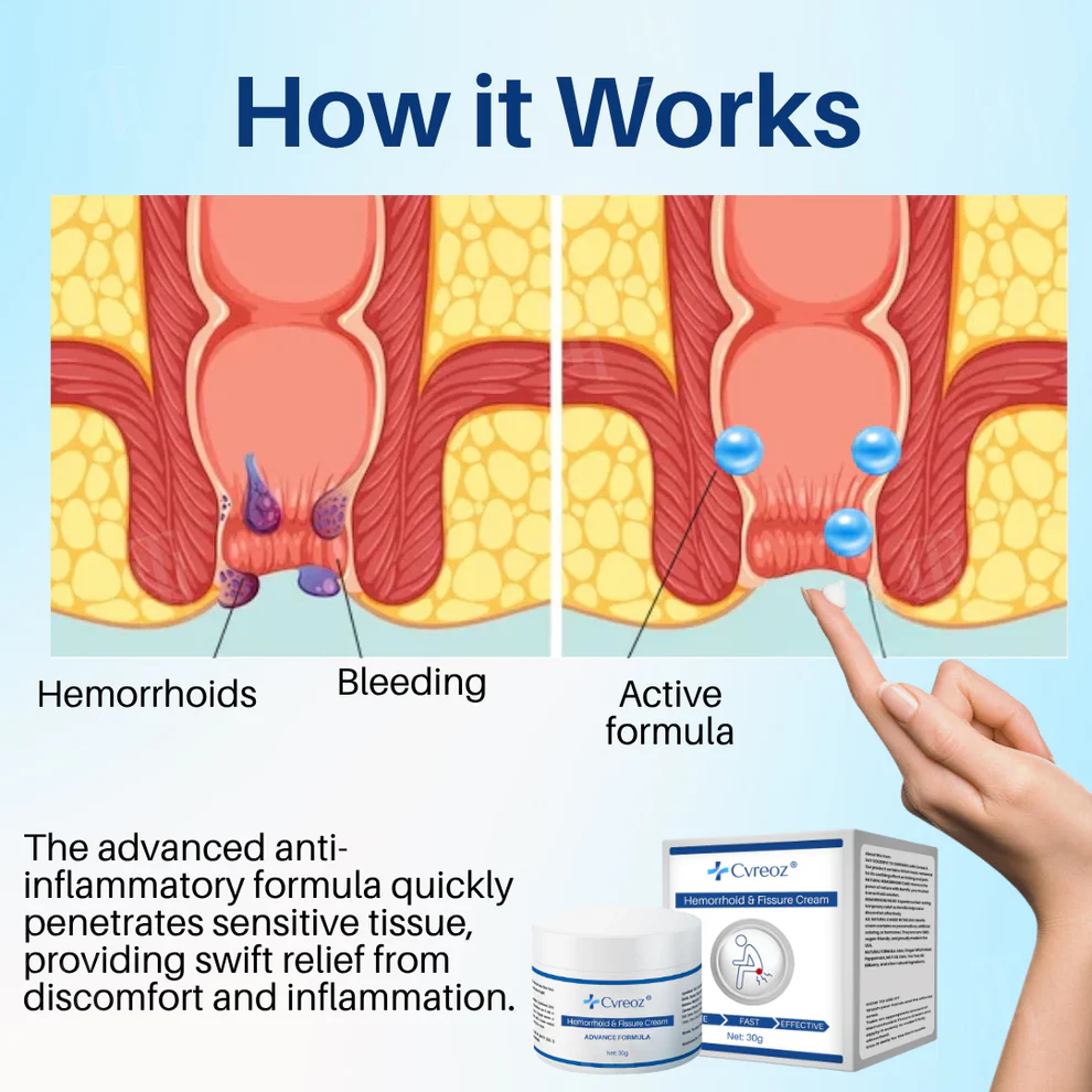 Cvreoz® Hemorrhoid & Fissure Cream 4 Cvreoz® Hemorrhoid & Fissure Cream