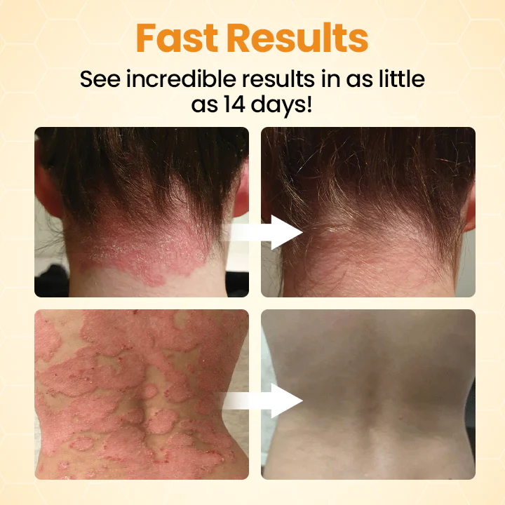 Cvreoz® BeeLief Psoriasis Skin Care Cream 7 Cvreoz® BeeLief Psoriasis Skin Care Cream