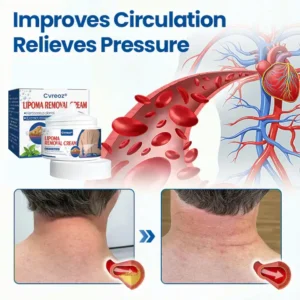 Cvreoz® Lipoma Removal Cream