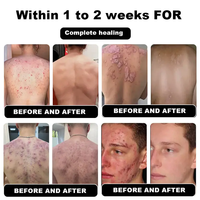 NESLEMY™ Psoriasis Cure Cream