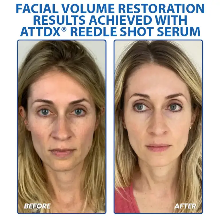 ATTDX® PDRN-NAD+ Cica Reedle Shot Serum