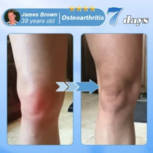 EQVP® Official Store Hyaluronic Acid Nano-microneedle Joint Patch